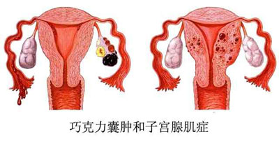 广州40岁借卵哪家好_通过基因表达对巧克力囊肿进行保守治疗